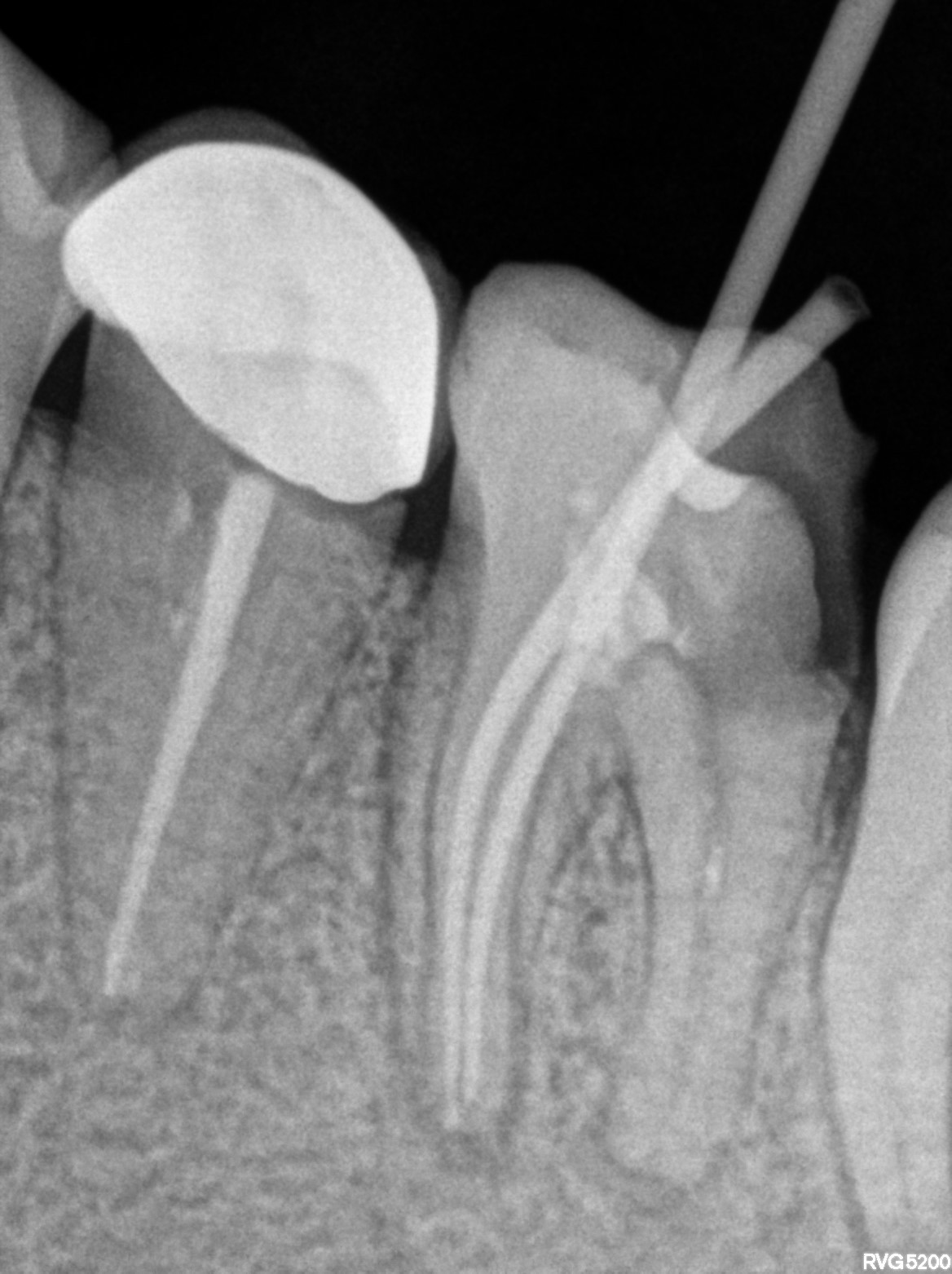 Dental X-ray